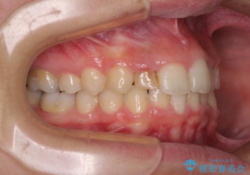 【モニター】前歯のデコボコと変色した前歯をインビザラインとオールセラミッククラウンでの治療中