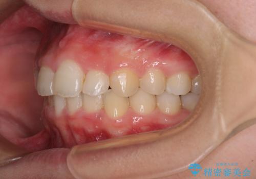 【モニター】前歯のデコボコと変色した前歯をインビザラインとオールセラミッククラウンでの治療中