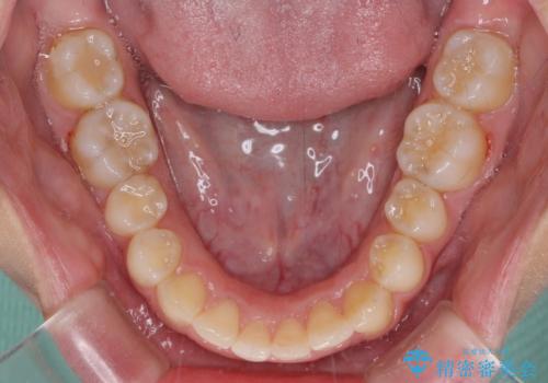 【モニター】前歯のデコボコと変色した前歯をインビザラインとオールセラミッククラウンでの治療中