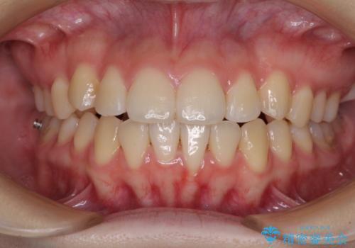 カリエール・ディスタライザーとインビザラインを用いた八重歯の改善の治療中