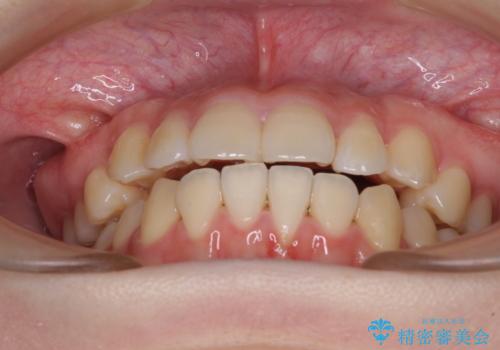 カリエール・ディスタライザーとインビザラインを用いた八重歯の改善の治療中
