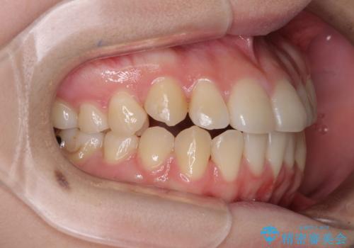 カリエール・ディスタライザーとインビザラインを用いた八重歯の改善の治療中