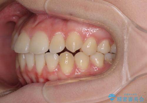 カリエール・ディスタライザーとインビザラインを用いた八重歯の改善の治療中