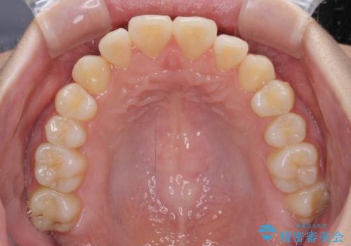 カリエール・ディスタライザーとインビザラインを用いた八重歯の改善の治療中