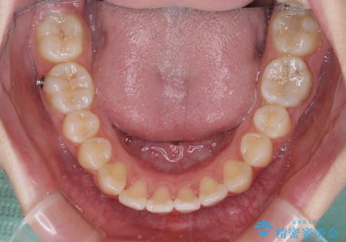 カリエール・ディスタライザーとインビザラインを用いた八重歯の改善の治療中