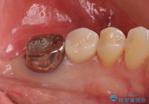 銀歯のやりかえ。の治療前