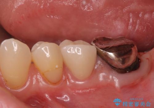 銀歯のやりかえ。の治療前