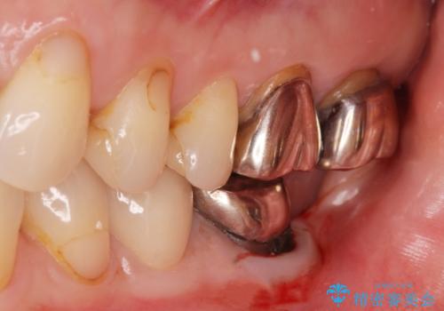 銀歯のやりかえ。の治療前