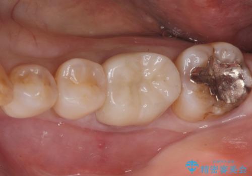 銀歯が取れた。の治療後
