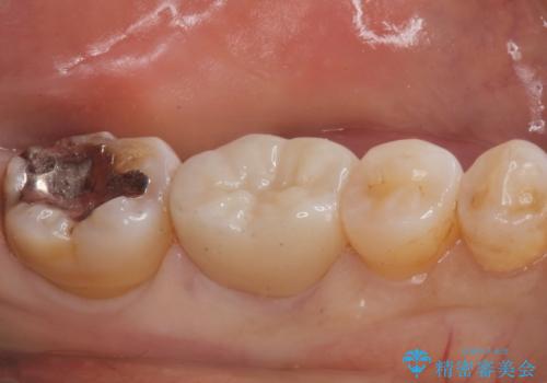 銀歯が取れた。の治療後