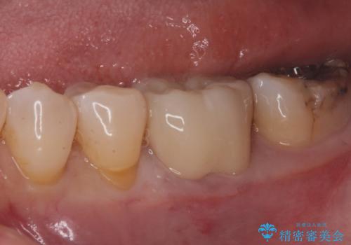 銀歯が取れた。の治療後