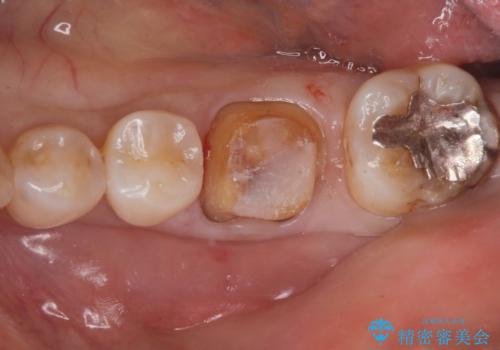 銀歯が取れた。の治療中