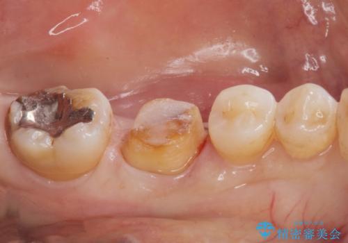 銀歯が取れた。の治療中