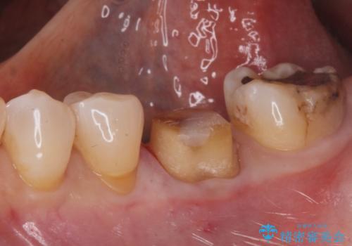 銀歯が取れた。の治療中