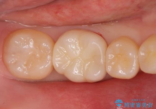 食べ物食べたら歯が欠けた。の治療後
