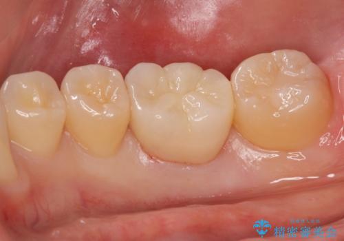 食べ物食べたら歯が欠けた。の治療後