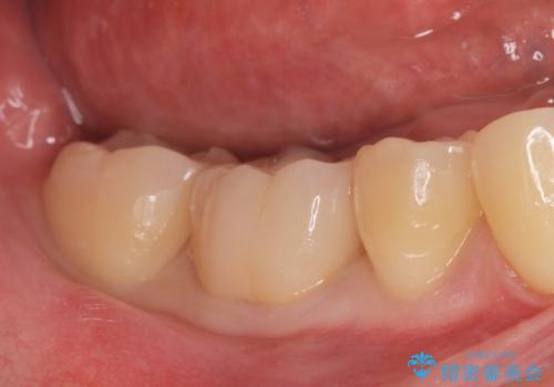 食べ物食べたら歯が欠けた。の治療後