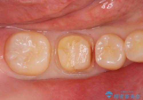 食べ物食べたら歯が欠けた。の治療中