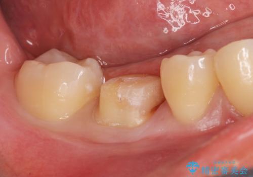 食べ物食べたら歯が欠けた。の治療中