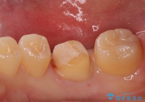 食べ物食べたら歯が欠けた。の治療中