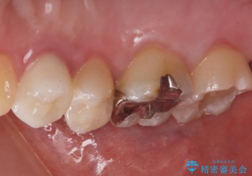 奥の歯に穴が空いているの治療中