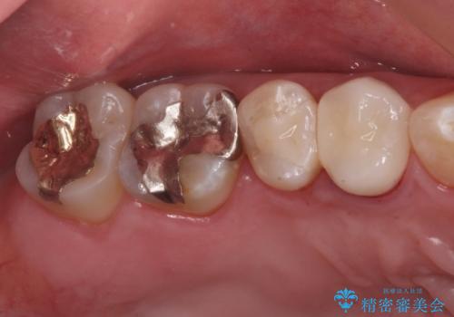 奥の歯に穴が空いているの症例 治療後