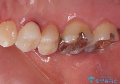 奥の歯に穴が空いているの治療後