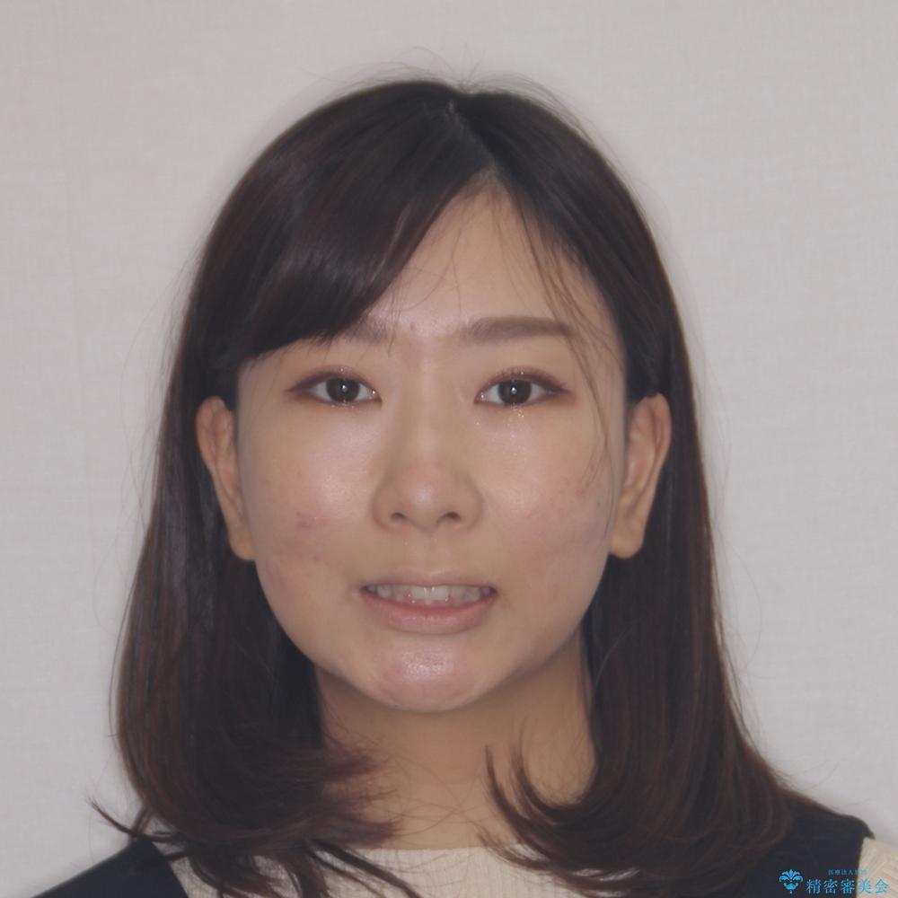 【モニター】前歯の変色とデコボコを改善 インビザラインとオールセラミックの治療前(顔貌)