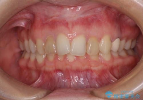 【モニター】前歯の変色とデコボコを改善　インビザラインとオールセラミックの治療前