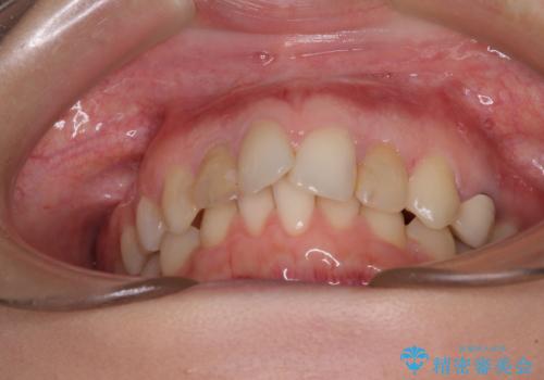 【モニター】前歯の変色とデコボコを改善 インビザラインとオールセラミックの治療前