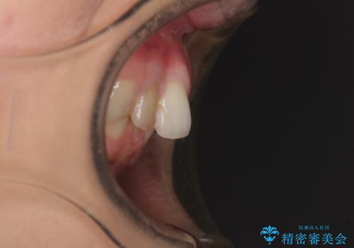 【モニター】前歯の変色とデコボコを改善 インビザラインとオールセラミックの治療前