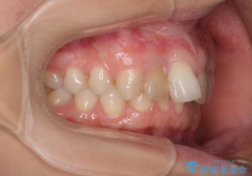 【モニター】前歯の変色とデコボコを改善 インビザラインとオールセラミックの治療前