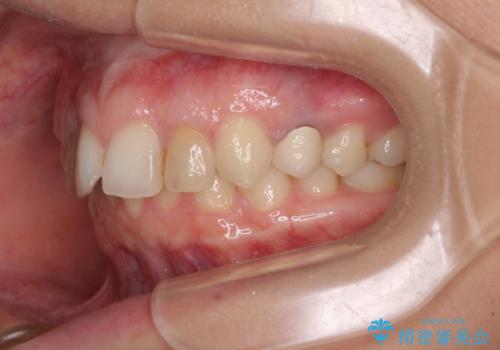 【モニター】前歯の変色とデコボコを改善 インビザラインとオールセラミックの治療前