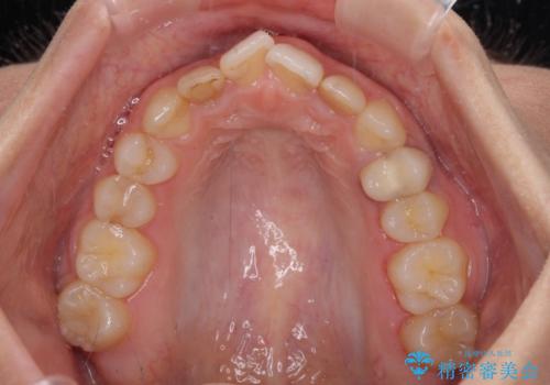 【モニター】前歯の変色とデコボコを改善 インビザラインとオールセラミックの治療前