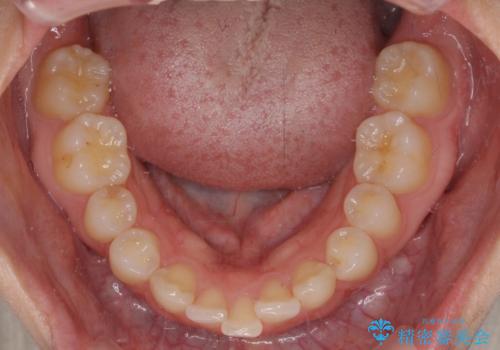 【モニター】前歯の変色とデコボコを改善 インビザラインとオールセラミックの治療前