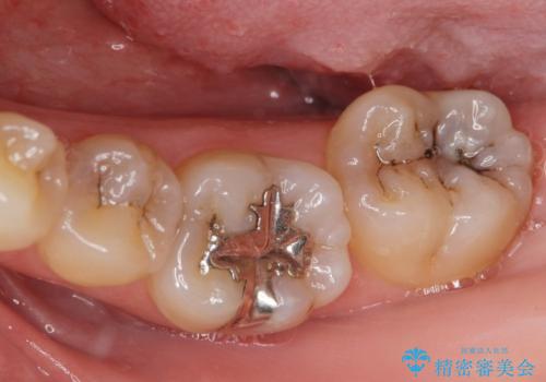 矯正前の虫歯治療の症例 治療前