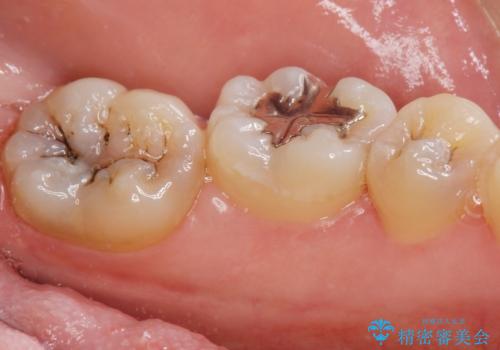 矯正前の虫歯治療の治療前