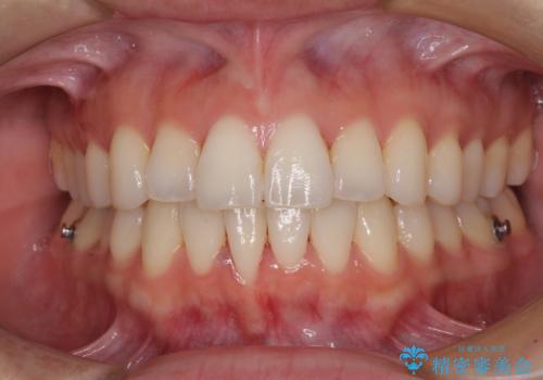 前歯のクロスバイト インビザラインによる矯正治療の治療中