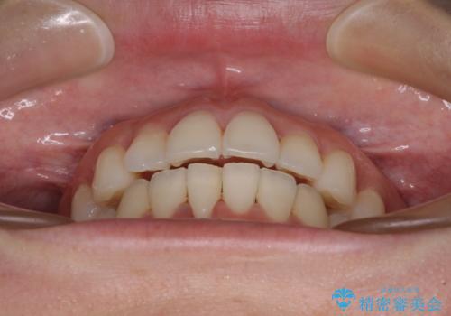 前歯のクロスバイト インビザラインによる矯正治療の治療中