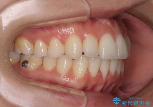 前歯のクロスバイト インビザラインによる矯正治療の治療中