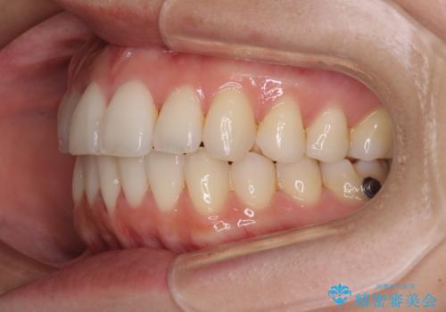 前歯のクロスバイト インビザラインによる矯正治療の治療中