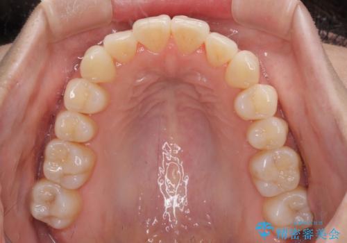前歯のクロスバイト インビザラインによる矯正治療の治療中