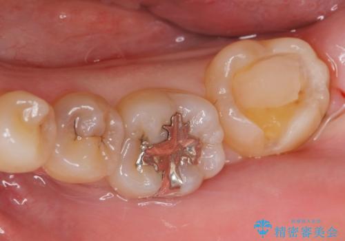 矯正前の虫歯治療の治療中