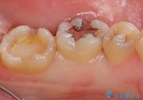 矯正前の虫歯治療の治療中