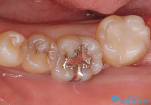 矯正前の虫歯治療の症例 治療後