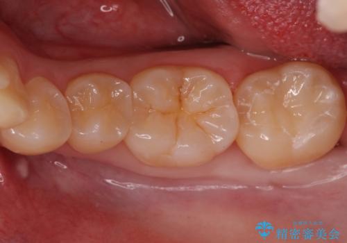 奥歯の虫歯　セラミックインレーでの治療の症例 治療後
