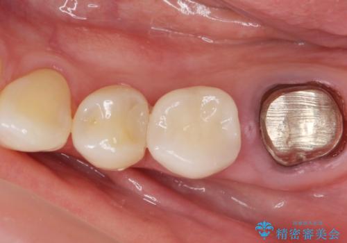 銀歯のやりかえ。の治療中