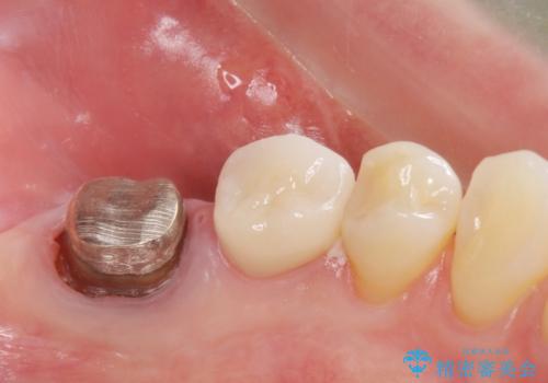 銀歯のやりかえ。の治療中
