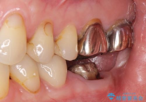 銀歯のやりかえ。の治療中