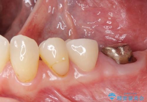 銀歯のやりかえ。の治療中